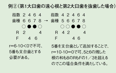例②（第1大臼歯の遠心根と第2大臼歯を抜歯した場合）